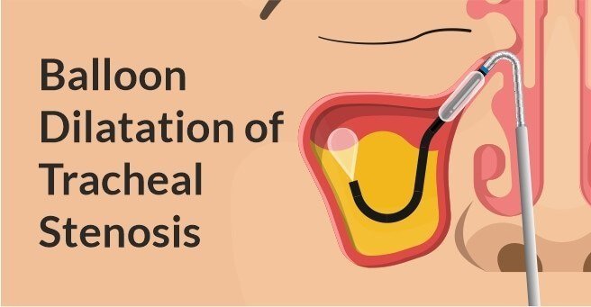 Balloon-Dilatation-of-Tracheal-Stenosis-case2